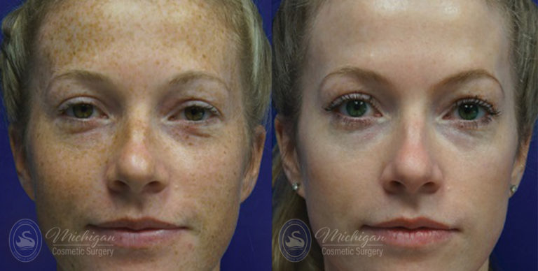 Pigment & Redness Before and After Photo by Dr. Awada in Southfield Michigan