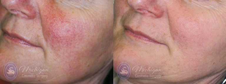 Pigment & Redness Before and After Photo by Dr. Awada in Southfield Michigan