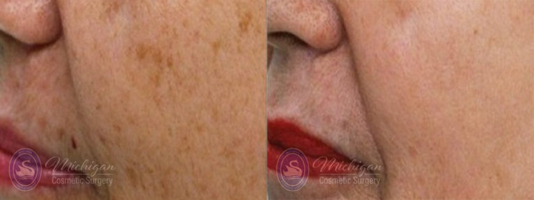 Pigment & Redness Before and After Photo by Dr. Awada in Southfield Michigan