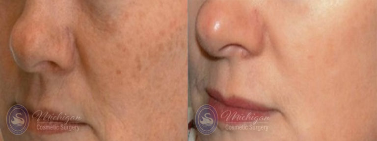 Pigment & Redness Before and After Photo by Dr. Awada in Southfield Michigan