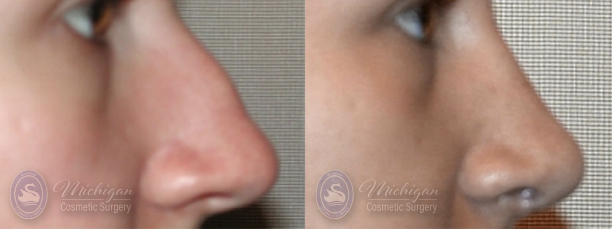 Rhinoplasty Results Southfield Michigan