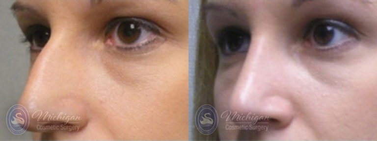 Rhinoplasty Before and After Photo by Dr. Awada in Southfield Michigan