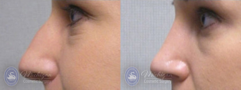 Rhinoplasty Before and After Photo by Dr. Awada in Southfield Michigan