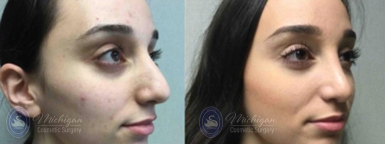 Rhinoplasty Before and After Photo by Dr. Awada in Southfield Michigan