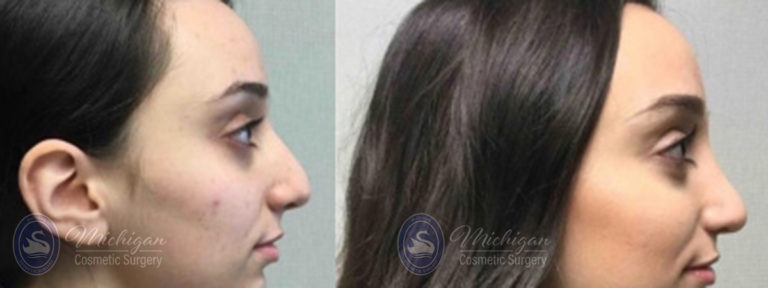 Rhinoplasty Before and After Photo by Dr. Awada in Southfield Michigan