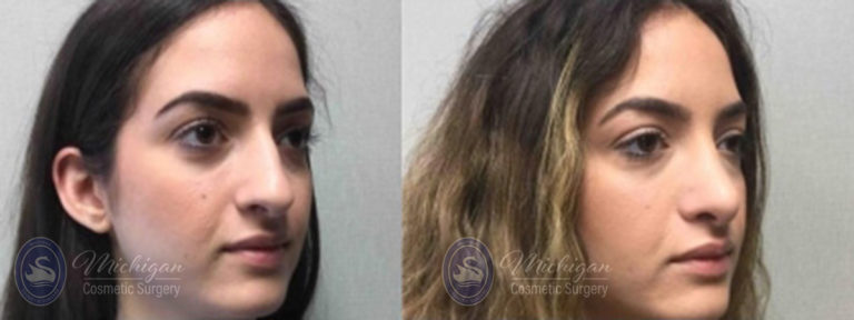Rhinoplasty Before and After Photo by Dr. Awada in Southfield Michigan