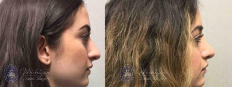 Rhinoplasty Before and After Photo by Dr. Awada in Southfield Michigan