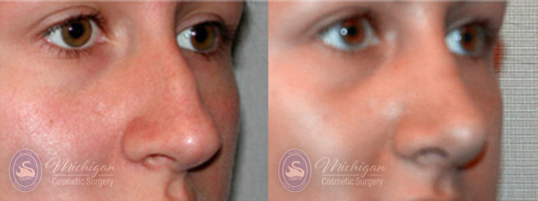 Rhinoplasty Before and After Photo by Dr. Awada in Southfield Michigan