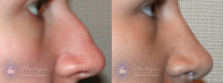 Rhinoplasty Before and After Photo by Dr. Awada in Southfield Michigan