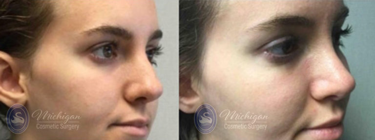 Rhinoplasty Before and After Photo by Dr. Awada in Southfield Michigan