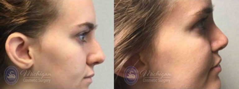 Rhinoplasty Before and After Photo by Dr. Awada in Southfield Michigan