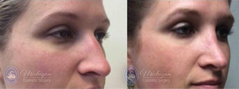 Rhinoplasty Before and After Photo by Dr. Awada in Southfield Michigan