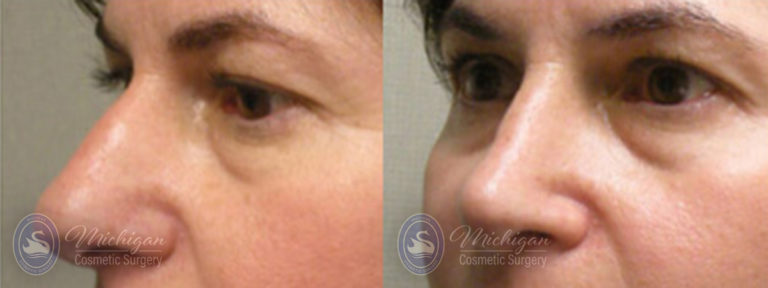 Rhinoplasty Before and After Photo by Dr. Awada in Southfield Michigan