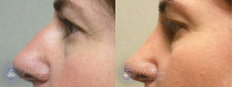 Rhinoplasty Before and After Photo by Dr. Awada in Southfield Michigan