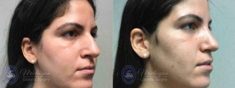 Rhinoplasty Before and After Photo by Dr. Awada in Southfield Michigan