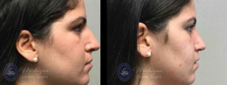 Rhinoplasty Before and After Photo by Dr. Awada in Southfield Michigan