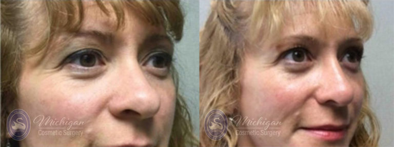 Rhinoplasty Before and After Photo by Dr. Awada in Southfield Michigan
