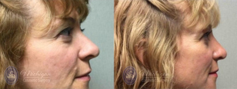 Rhinoplasty Before and After Photo by Dr. Awada in Southfield Michigan