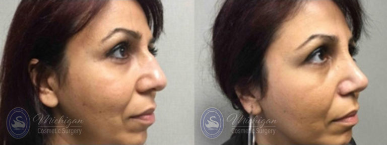 Rhinoplasty Before and After Photo by Dr. Awada in Southfield Michigan