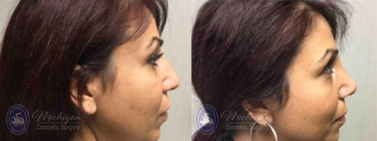 Rhinoplasty Before and After Photo by Dr. Awada in Southfield Michigan