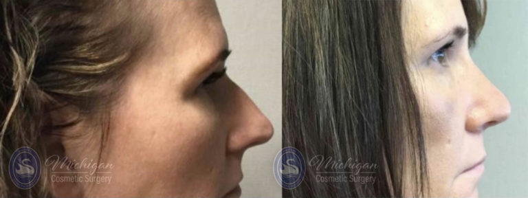 Rhinoplasty Before and After Photo by Dr. Awada in Southfield Michigan