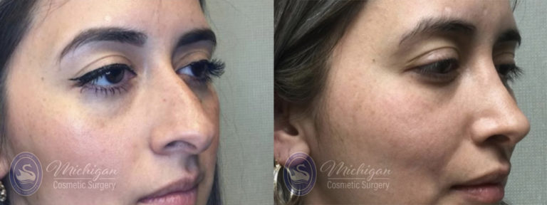 Rhinoplasty Before and After Photo by Dr. Awada in Southfield Michigan