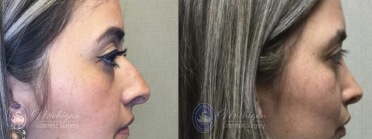 Rhinoplasty Before and After Photo by Dr. Awada in Southfield Michigan