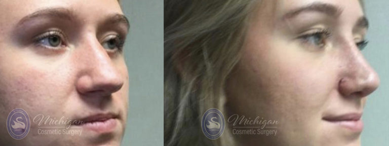 Rhinoplasty Before and After Photo by Dr. Awada in Southfield Michigan