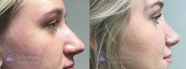 Rhinoplasty Before and After Photo by Dr. Awada in Southfield Michigan