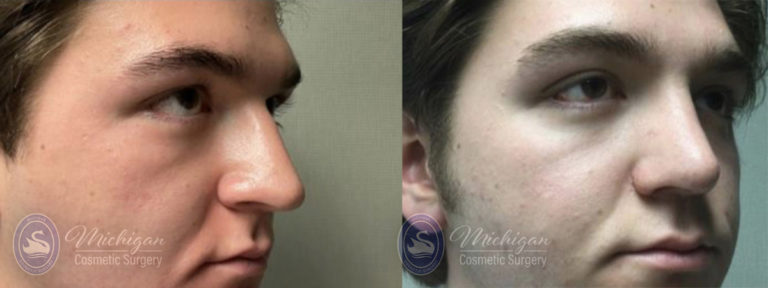 Rhinoplasty Before and After Photo by Dr. Awada in Southfield Michigan