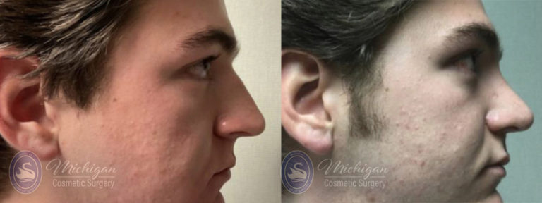 Rhinoplasty Before and After Photo by Dr. Awada in Southfield Michigan