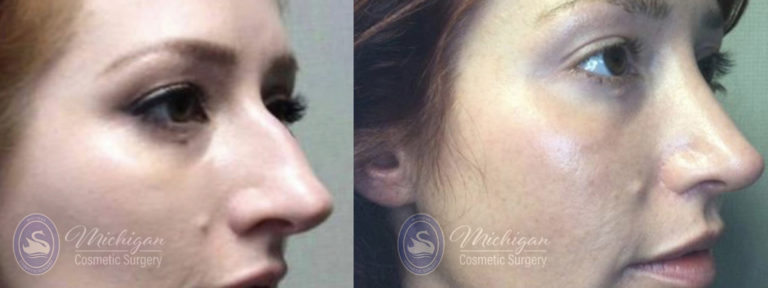 Rhinoplasty Before and After Photo by Dr. Awada in Southfield Michigan