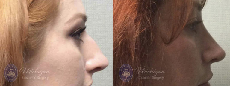Rhinoplasty Before and After Photo by Dr. Awada in Southfield Michigan