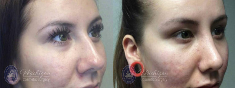 Rhinoplasty Before and After Photo by Dr. Awada in Southfield Michigan