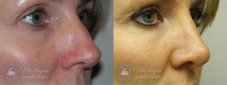 Rhinoplasty Before and After Photo by Dr. Awada in Southfield Michigan