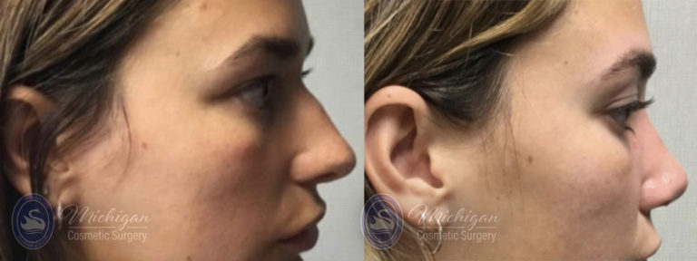 Rhinoplasty Before and After Photo by Dr. Awada in Southfield Michigan