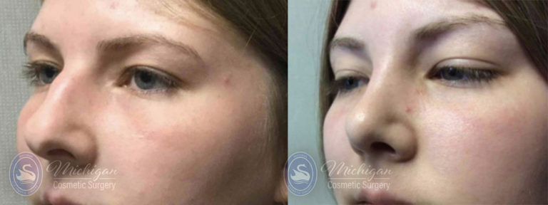 Rhinoplasty Before and After Photo by Dr. Awada in Southfield Michigan