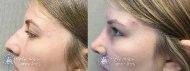 Rhinoplasty Before and After Photo by Dr. Awada in Southfield Michigan