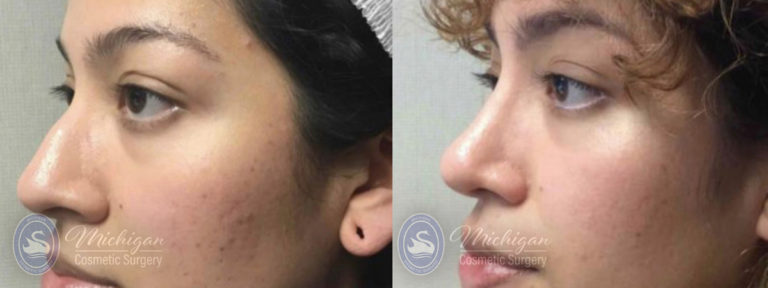 Rhinoplasty Before and After Photo by Dr. Awada in Southfield Michigan