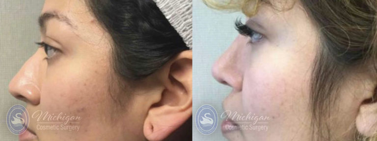 Rhinoplasty Before and After Photo by Dr. Awada in Southfield Michigan