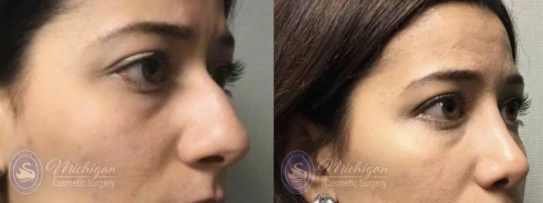 Rhinoplasty Before and After Photo by Dr. Awada in Southfield Michigan