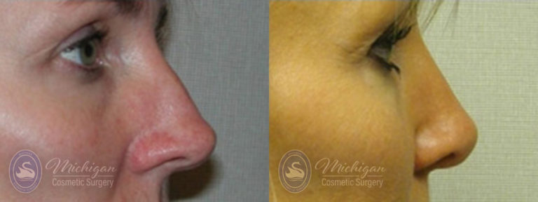 Rhinoplasty Before and After Photo by Dr. Awada in Southfield Michigan