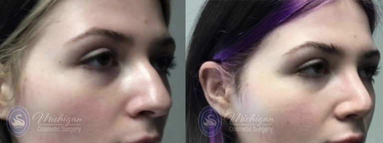 Rhinoplasty Before and After Photo by Dr. Awada in Southfield Michigan