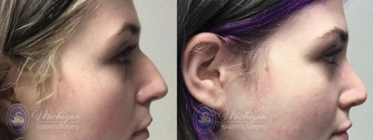 Rhinoplasty Before and After Photo by Dr. Awada in Southfield Michigan