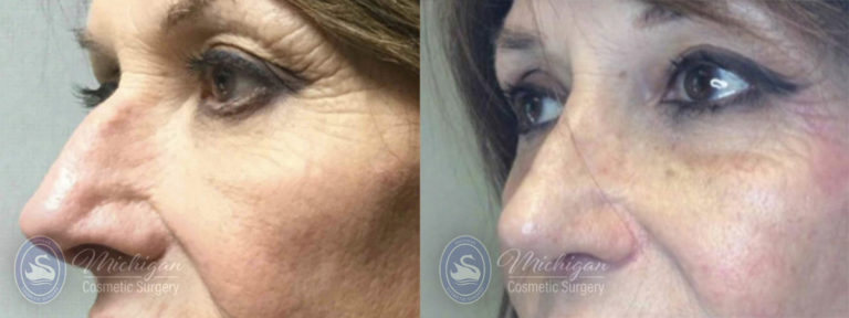Rhinoplasty Before and After Photo by Dr. Awada in Southfield Michigan