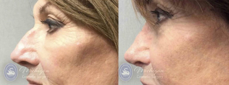 Rhinoplasty Before and After Photo by Dr. Awada in Southfield Michigan
