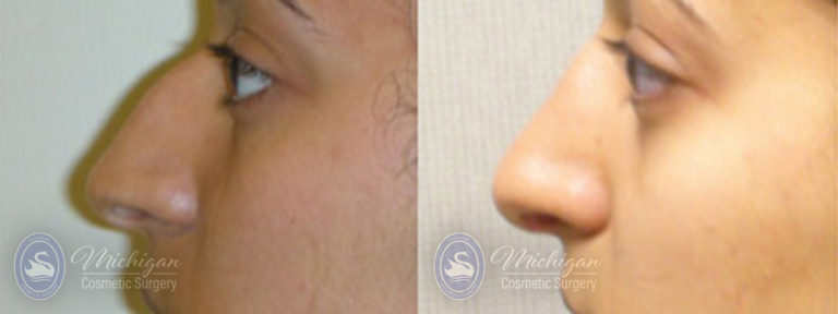 Rhinoplasty Before and After Photo by Dr. Awada in Southfield Michigan