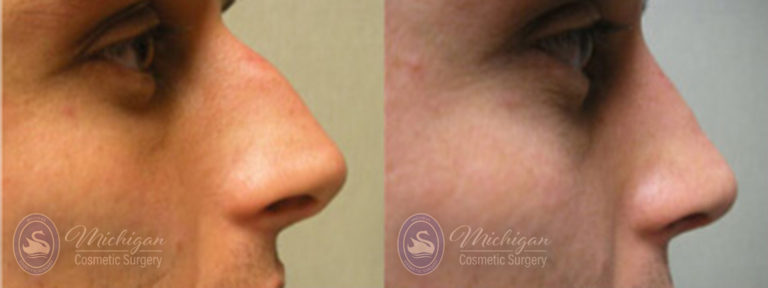 Rhinoplasty Before and After Photo by Dr. Awada in Southfield Michigan