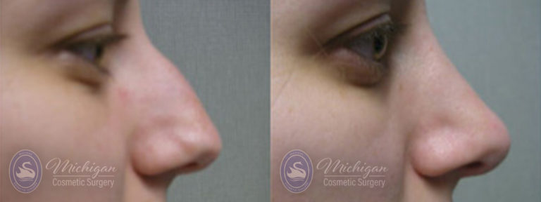 Rhinoplasty Before and After Photo by Dr. Awada in Southfield Michigan