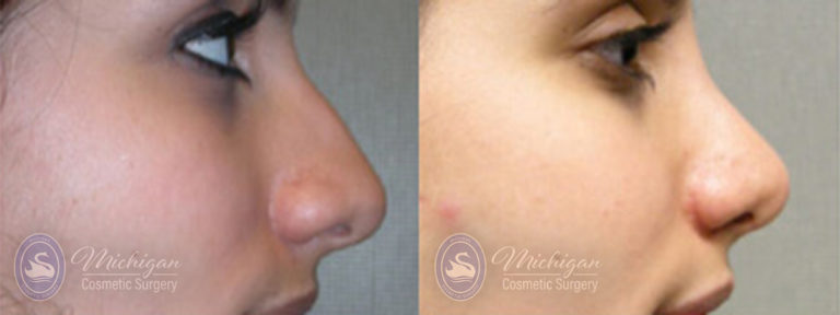 Rhinoplasty Before and After Photo by Dr. Awada in Southfield Michigan